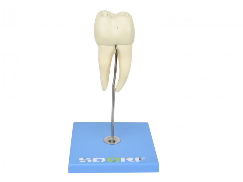 DENTE MOLAR INFERIOR C/ RAIZ DUPLA EM 3 PARTES C/ CÁRIE, 8X O TAMANHO REAL APROX.