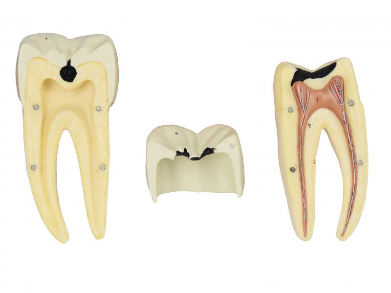 DENTE MOLAR INFERIOR C/ RAIZ DUPLA EM 3 PARTES C/ CÁRIE, 8X O TAMANHO REAL APROX.