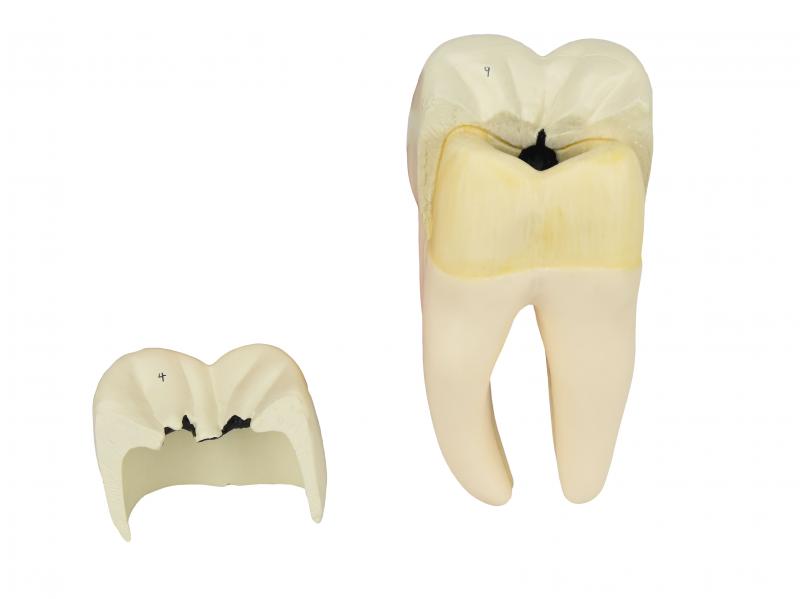 DENTE MOLAR INFERIOR C/ RAIZ DUPLA EM 3 PARTES C/ CÁRIE, 8X O TAMANHO REAL APROX.